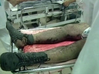 strange wound