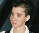 Brian has large scars from being shot in the face by an Israeli soldier.