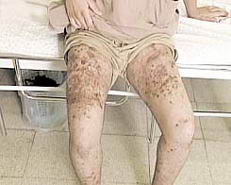 Wounds inflicted by the experimental weapons used in strike on the Gaza Strip.
