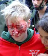 19-year-old Tove Johansson's face is covered with blood.
